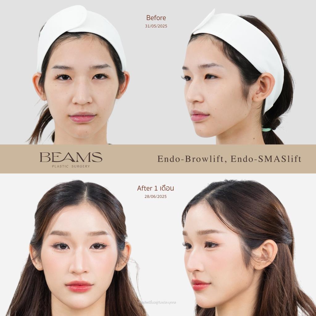 รีวิวยกคิ้วส่องกล้องคุณตาล
