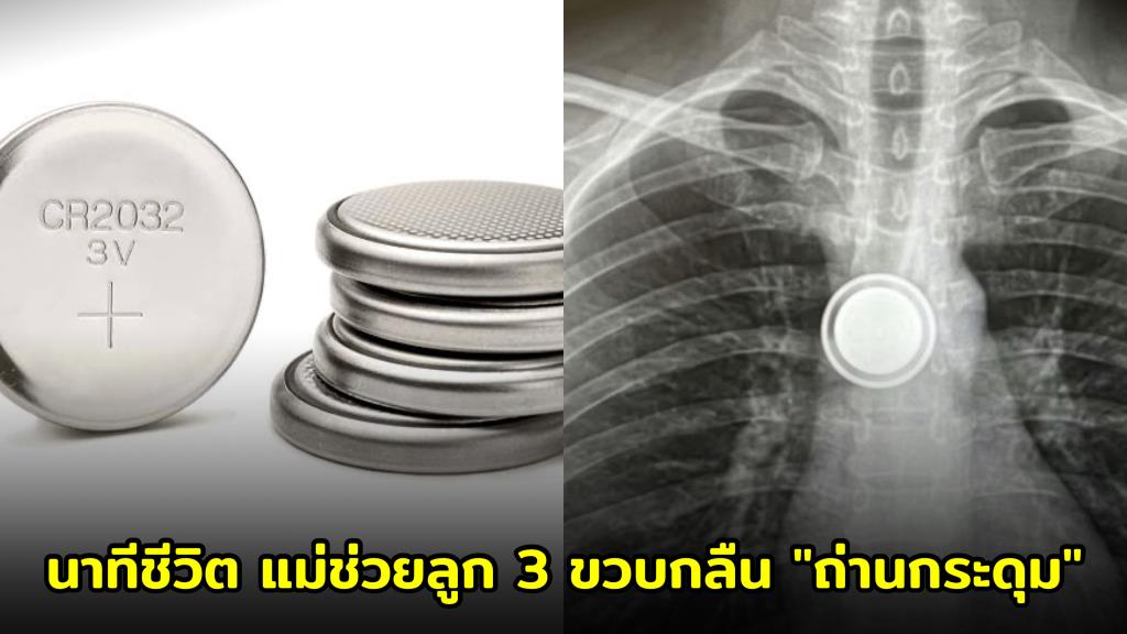 นาทีชีวิต! แม่สติแกร่งช่วยลูก 3 ขวบกลืน "ถ่านกระดุม" เผยเคล็ดลับ "น้ำผึ้ง" ฮีโร่ประวิงเวลาก่อนถึงมือหมอ