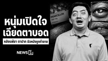 หนุ่มเล่าประสบการณ์เฉียดตาบอด หลังแพ้ยาเพนิซิลลินรุนแรง ป่วย “สตีเวนส์-จอห์นสัน ซินโดรม” จนตา ปาก และผิวหนังถูกทำลาย