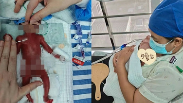 ตัวเท่าฝ่ามือ! แม่จีนคลอดลูกชายก่อนกำหนด หนักเพียง 330 กรัม ลุ้น 105 วัน น้ำหนักพุ่ง 2.5 กก.จนได้กลับบ้าน