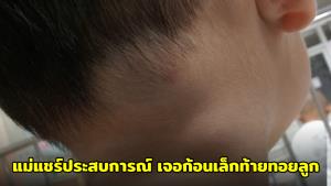 แม่แชร์ประสบการณ์ เจอก้อนเล็กท้ายทอยลูก กลายเป็นมะเร็งต่อมน้ำเหลือง เตือนพ่อแม่อย่ามองข้าม
