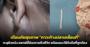 เตือนภัยสุขภาพ "ภาวะก้างปลาเคลื่อนที่" ทะลุผิวหนัง แพทย์ชี้อันตรายถึงชีวิต พร้อมแนะวิธีรับมือที่ถูกต้อง