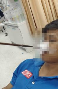 (คลิป)ระทึกนาทีชีวิต! หนุ่มโคราชถูกคู่อริยิงปืนลูกดอกเหล็กปักคาใบหน้าสาหัส กู้ภัยใช้เครื่องพลาสมาตัดออกช่วยชีวิต