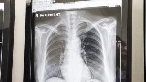 นวัตกรรม “Low Dose CT” ทางเลือกใหม่ตรวจคัดกรองมะเร็งปอดระยะแรก  รังสีต่ำกว่าปกติ 5 เท่า ไม่ต้องงดน้ำ-อาหาร ตอบโจทย์คนยุค PM 2.5