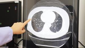 นวัตกรรม “Low Dose CT” ทางเลือกใหม่ตรวจคัดกรองมะเร็งปอดระยะแรก  รังสีต่ำกว่าปกติ 5 เท่า ไม่ต้องงดน้ำ-อาหาร ตอบโจทย์คนยุค PM 2.5