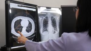 นวัตกรรม “Low Dose CT” ทางเลือกใหม่ตรวจคัดกรองมะเร็งปอดระยะแรก  รังสีต่ำกว่าปกติ 5 เท่า ไม่ต้องงดน้ำ-อาหาร ตอบโจทย์คนยุค PM 2.5