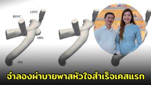แพทย์ มช.เจ๋ง! ใช้แบบจำลองเสมือนจริงวางแผนผ่าตัดบายพาสหัวใจ สำเร็จครั้งแรกในไทย